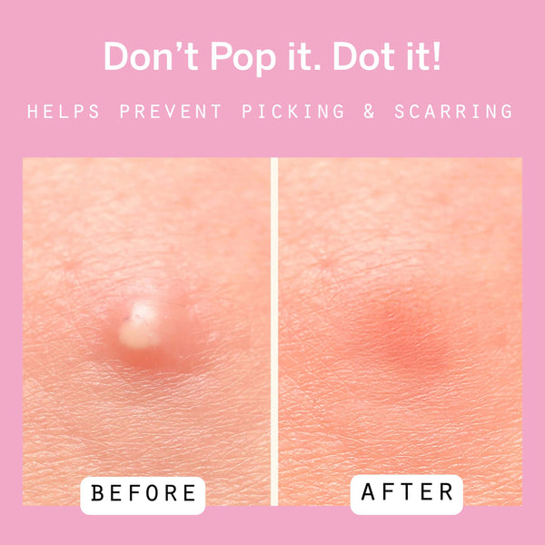 Load image into Gallery viewer, Dot Pimple Patches
